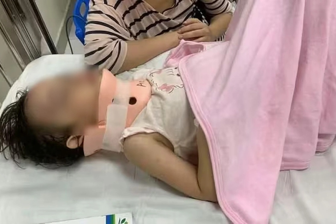 Bé gái bị xô ngã từ cầu trượt khu vui chơi bị vỡ xương trán