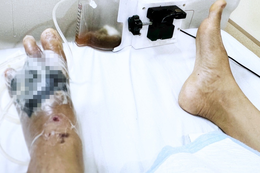 Đắp lá thuốc chữa bỏng, người đàn ông phải cắt 3 ngón chân