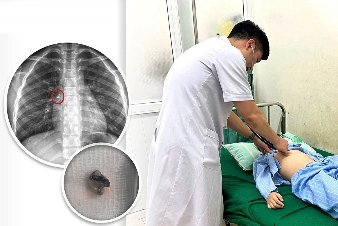 Bé trai nhập viện cấp cứu vì tình huống hi hữu khi nhổ răng