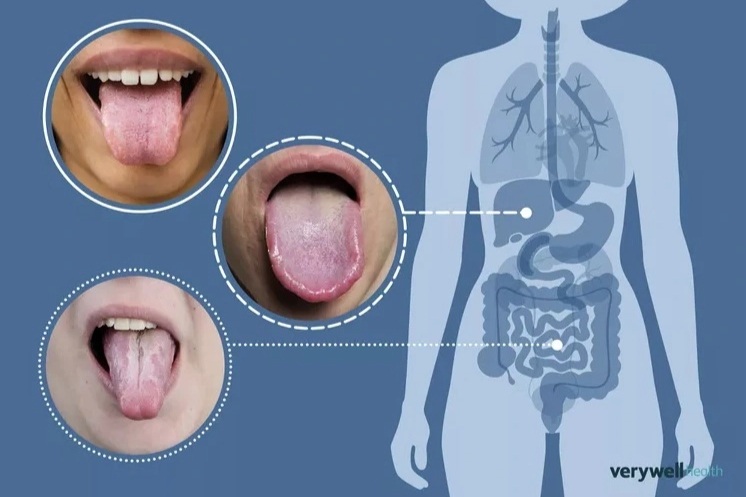Lưỡi tiết lộ gì về sức khỏe?