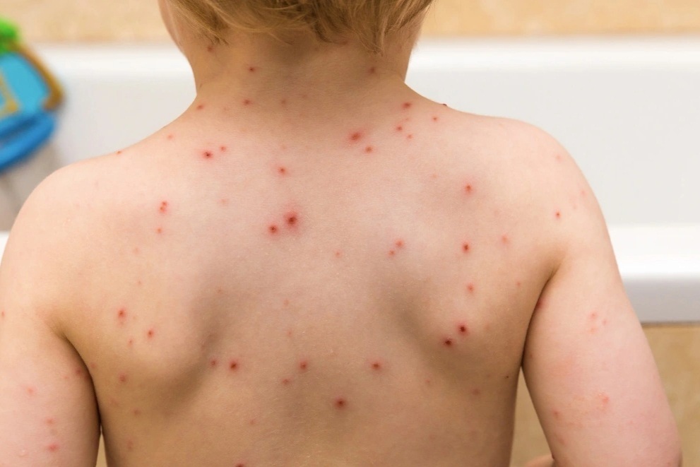 Khỏi thủy đậu vẫn chưa hết nguy cơ, virus có thể "ngủ đông" gây bệnh zona